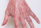 Nail Psoriasis - John C