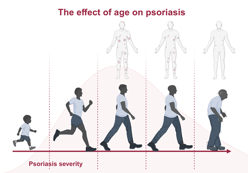 The effect of age on the severity of psoriasis – research summary ...