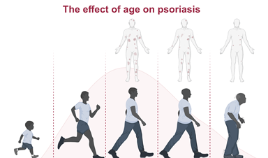 Ageing and Psoriasis