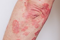 Arm Plaque Psoriasis