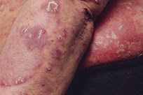 Erythrodermic psoriasis 1 -  An image of erythrodermic psoriasis on torso, arm & elbow