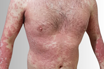 Erythrodermic psoriasis 3 - An image of erythrodermic psoriasis on torso & arms