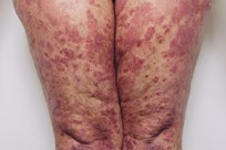 Erythrodermic psoriasis 4 - An image of erythrodermic psoriasis on upper legs & thighs