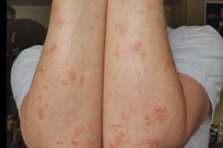 Guttate Psoriasis Image 1