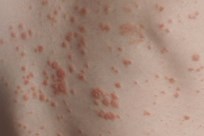 Guttate Psoriasis Image 2