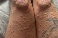 Guttate Psoriasis Image 4