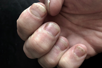 Nail Psoriasis Image 1