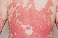 Plaque Psoriasis Image 4