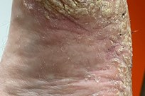 Pustular Psoriasis - Image 3