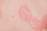 Plaque Psoriasis Image 1