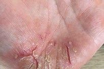 Pustular Psoriasis - Image 1