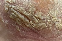 Pustular Psoriasis - Image 2