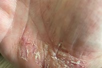 Pustular Psoriasis - Image 4