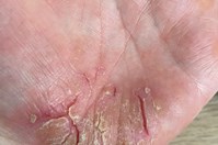 Pustular Psoriasis - Image 1