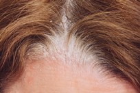 Scalp Psoriasis Image 1