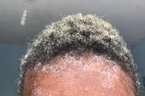 Scalp Psoriasis Image 2