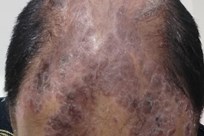 Scalp Psoriasis Image 3