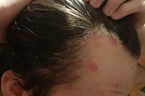 Scalp Psoriasis Image 4