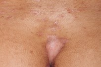 Sensitive Psoriasis Image 2