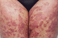 Sensitive Psoriasis Image 3