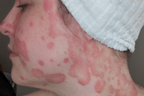 Sensitive Psoriasis Image 4